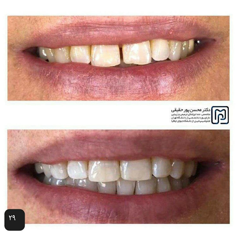 نمونه کار دکتر محسن پور حقیقی | متخصص دندانپزشکی زیبایی و ترمیمی در تهران