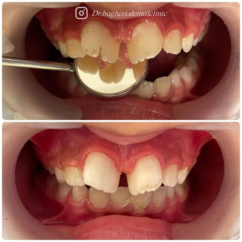 نمونه کار دکتر مهشید باقری | متخصص دندانپزشکی کودکان مشهد