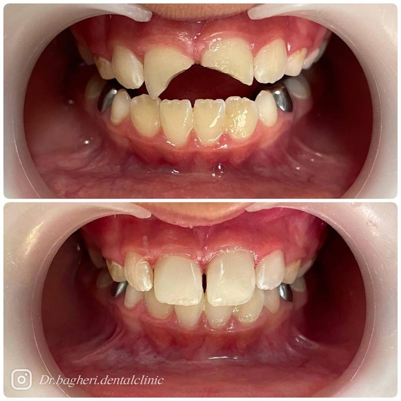 نمونه کار دکتر مهشید باقری | پزشک دندانپزشکی کودکان مشهد