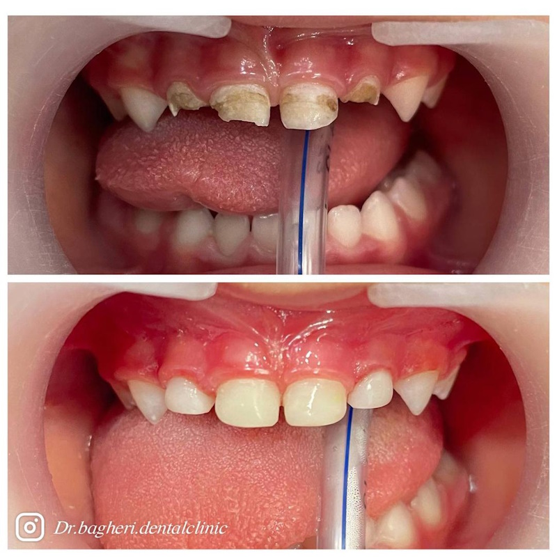 نمونه کار دکتر مهشید باقری | دکتر دندانپزشکی کودکان مشهد