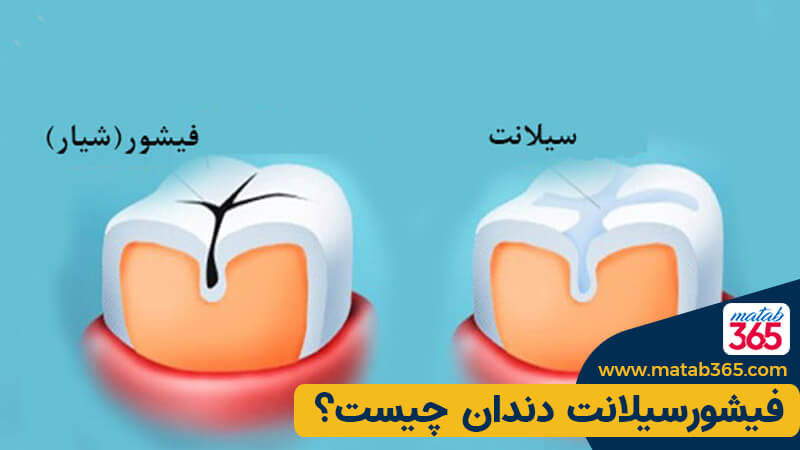 فیشور سیلانت دندان چیست ؟