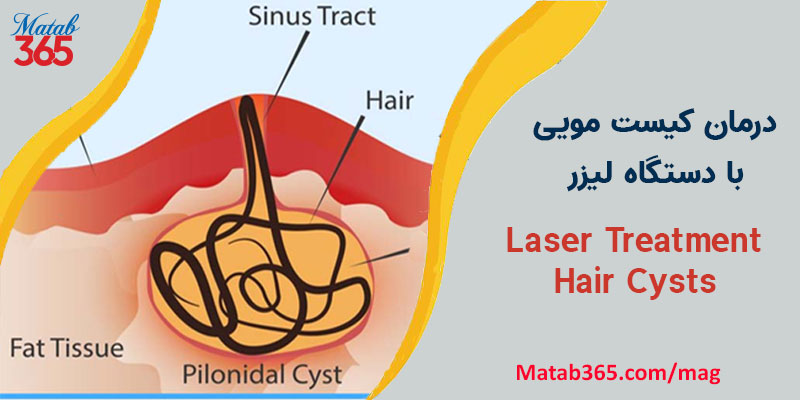 درمان کیست مویی با دستگاه لیزر 