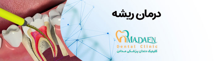 درمان ریشه دندان در کلینیک دندانپزشکی مدائن اصفهان