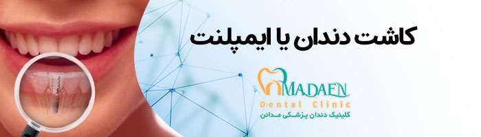 بخش ایمپلنت کلینیک دندانپزشکی مدائن اصفهان