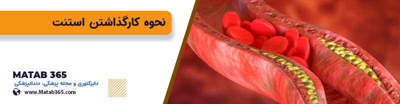 کار گذاشتن استت برای درمان بیماری قلبی
