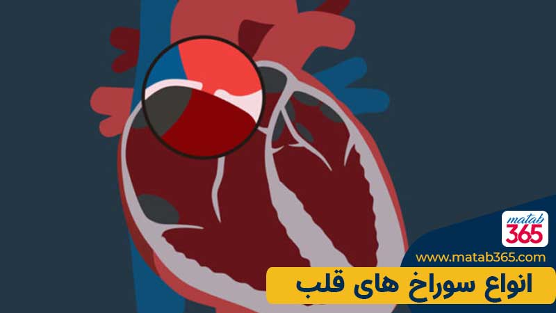 انواع سوراخ قلب
