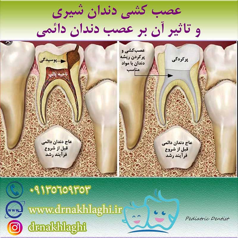 نمونه کار عصب کشی دندان کودکان در اصفهان توسط دکتر نجمه اخلاقی