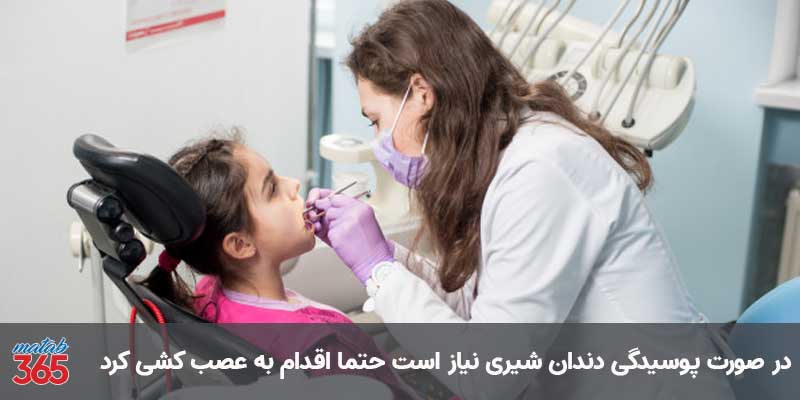 عصب کشی دندان شیری کودکان در اصفهان