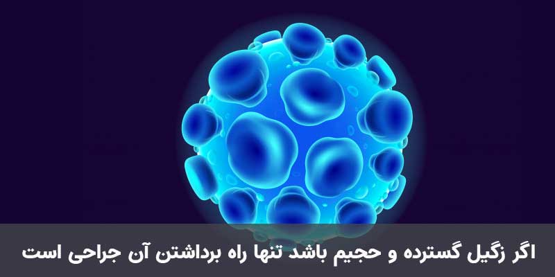 درمان زگیل تناسلی در اصفهان