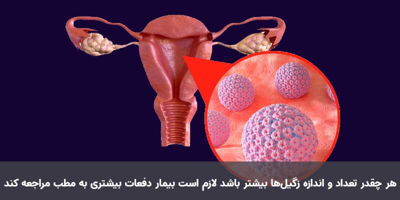 درمان بیماری زگیل تناسلی در اصفهان