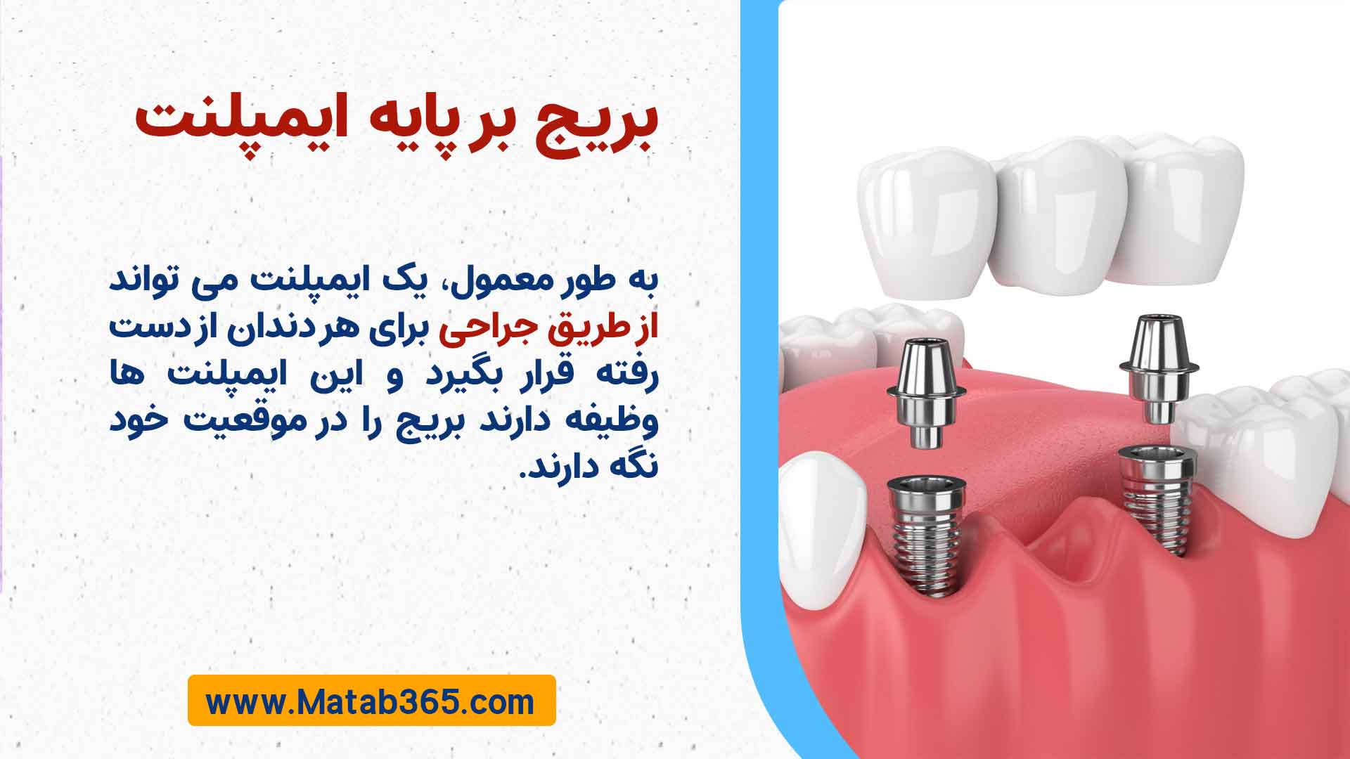بریج بر پایه ایمپلنت (Implant-supported dental bridge)