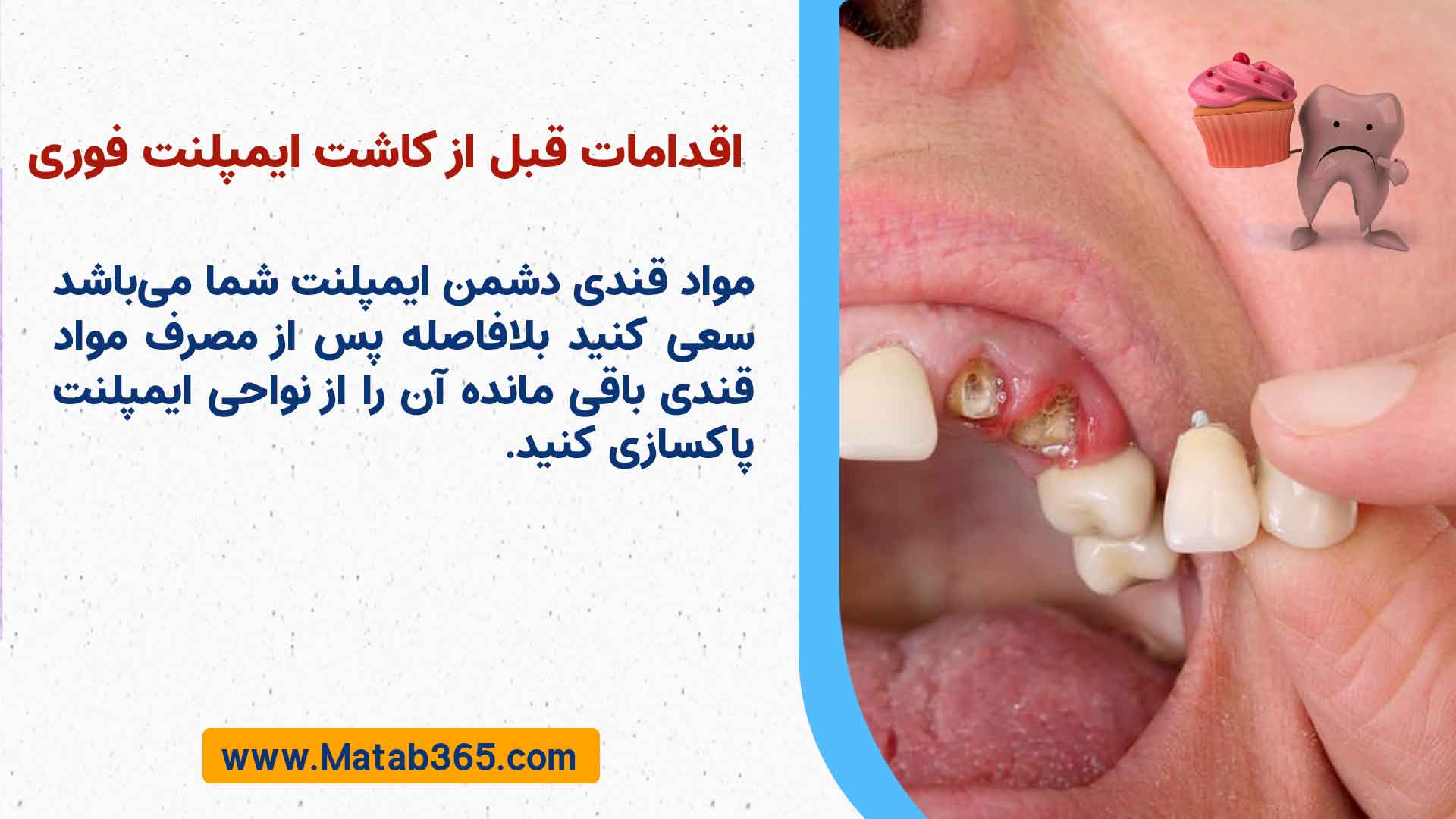 اقدامات پیش از کاشت ایمپلنت فوری