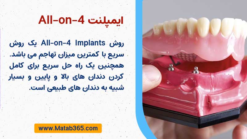 ایمپلنت های All-on-4 (All-on-4 implants)