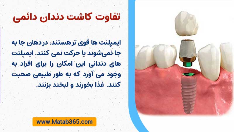 مقایسه کاشت دندان دائمی با دندان مصنوعی و پروتزهای جزئی