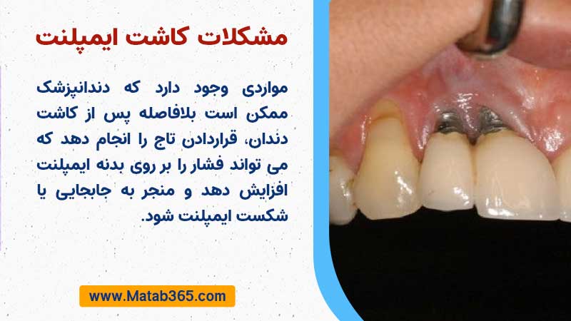 مشکلات کاشت ایمپلنت دندان