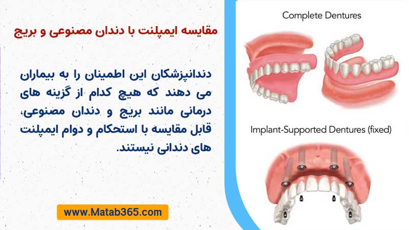 مقایسه استحکام ایمپلنت های دندانی با دندان مصنوعی و بریج دندان