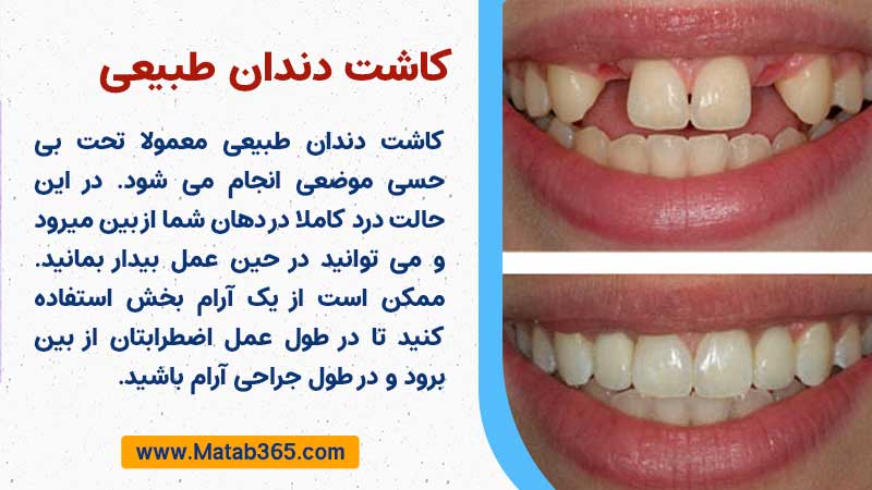 کاشت دندان طبیعی چگونه انجام می شود؟