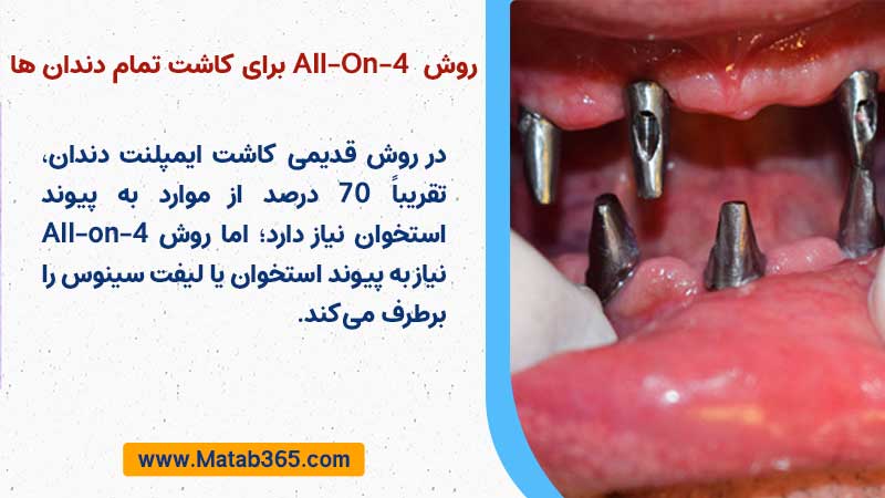 روش َAll-On-4 برای کاشت تمام دندان ها