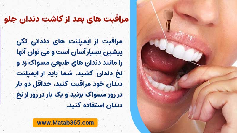 مراقبت های بعد از جراحی کاشت دندان جلو 