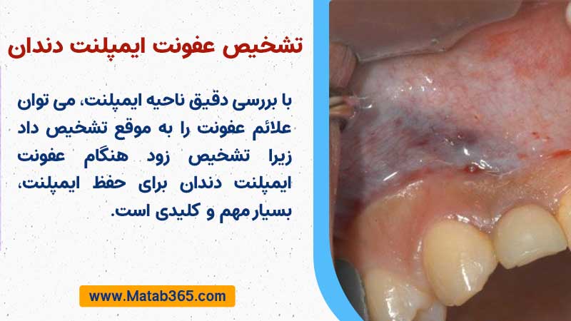 تشخیص عفونت ایمپلنت دندان