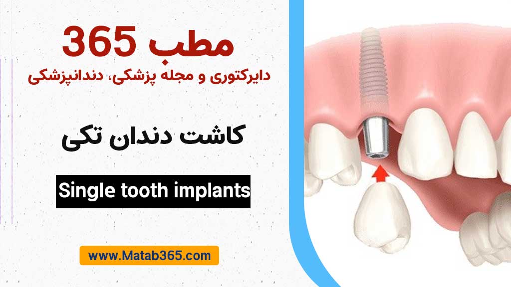 کاشت دندان تکی یا ایمپلنت تک دندان