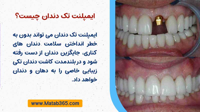 کاشت دندان تکی چیست؟