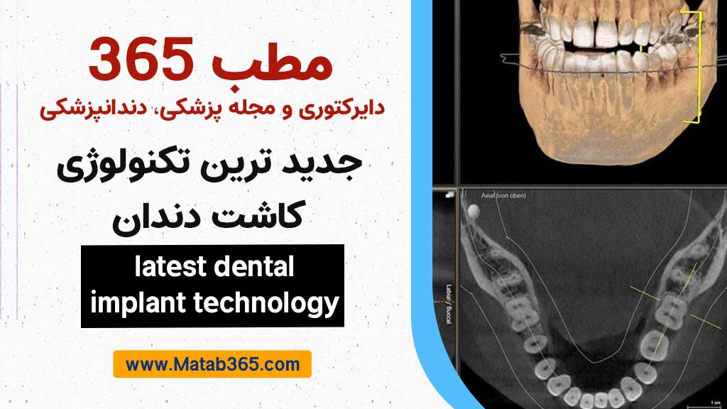 جدید ترین تکنولوژی کاشت دندان