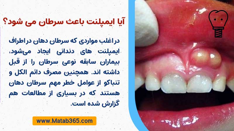 ایمپلنت دندان باعث سرطان می شود؟