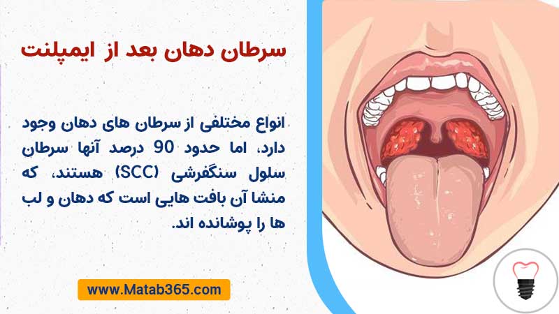 سرطان دهان بعد از ایمپلنت دندان