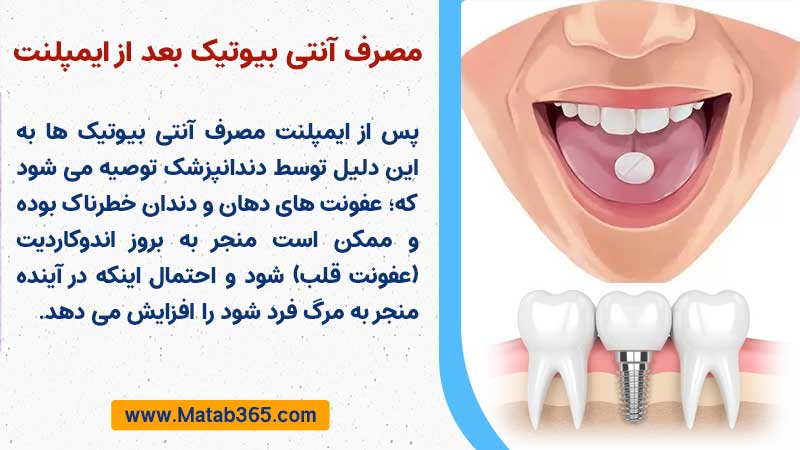 مصرف آنتی بیوتیک بعد از کاشت ایمپلنت دندان