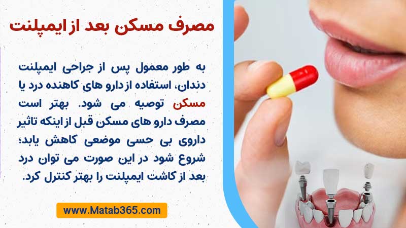 مصرف داروهای مسکن بعد از کاشت ایمپلنت دندان