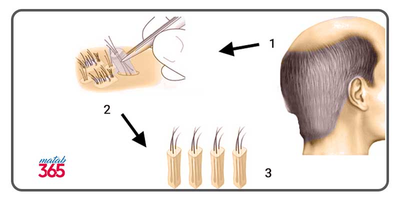 نحوه انجام کاشت مو و مراقبتهای بعد از پیوند مو