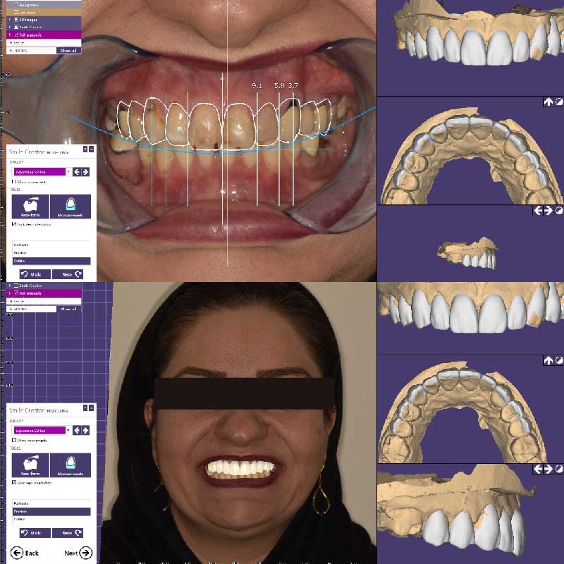 طراحی دیجیتالی انجام شده قبل از دندانپزشکی زیبایی