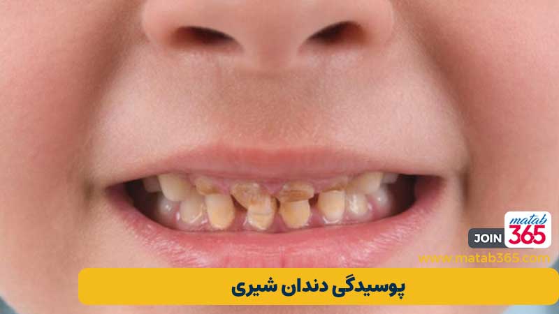پوسیدگی دندان شیری