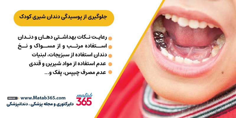 جلوگیری از پوسیدگی دندان شیری کودک