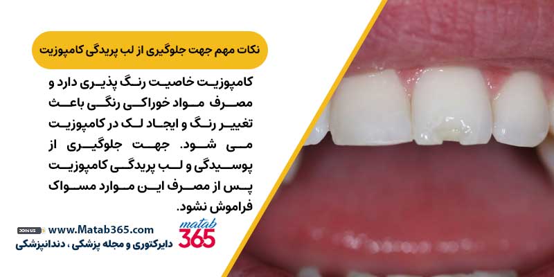 مراقبت های بعد از کامپوزیت دندان جهت جلوگیری از لب پریدگی کامپوزیت