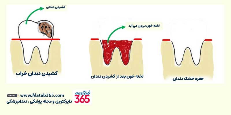 چرا حفره خشک دندان ایجاد می شود؟