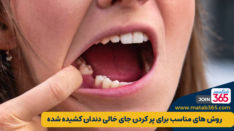 روش های مناسب برای پر کردن جای خالی دندان کشیده شده