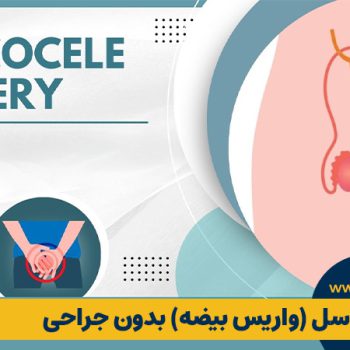 درمان واریکوسل (واریس بیضه) بدون جراحی: حقیقت علمی یا یک رؤیای دست‌نیافتنی؟ | مطب ۳۶۵