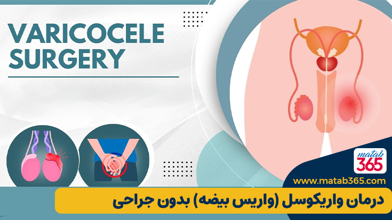 درمان واریکوسل (واریس بیضه) بدون جراحی: حقیقت علمی یا یک رؤیای دست‌نیافتنی؟ | مطب ۳۶۵