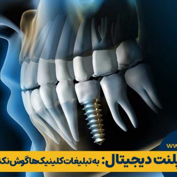 عوارض ایمپلنت دیجیتال: به تبلیغات کلینیک‌ها گوش نکنید!!! |‌مطب ۳۶۵
