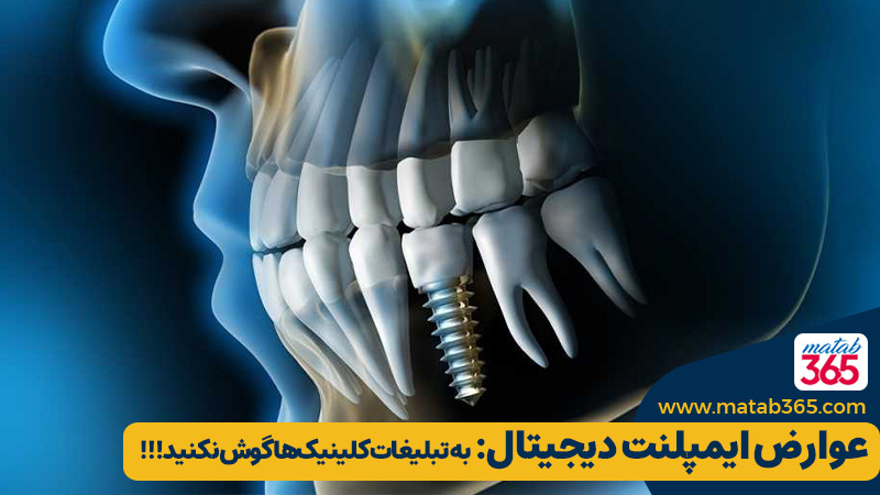 عوارض ایمپلنت دیجیتال: به تبلیغات کلینیکها گوش نکنید!!! |مطب ۳۶۵