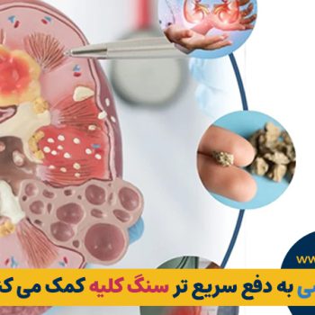 آیا رابطه جنسی به دفع سریع تر سنگ کلیه کمک می کند؟ (راهنمای عملی و بدون سانسور) | مطب ۳۶۵