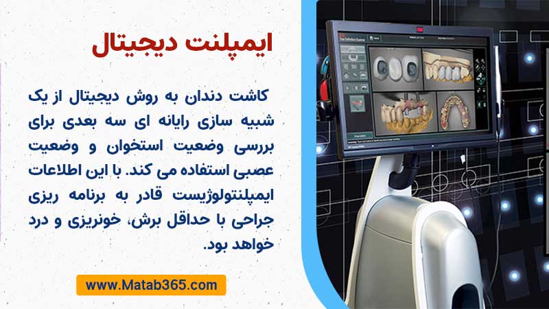 کاشت ایمپلنت دیجیتال توسط متخصص ایمپلنت