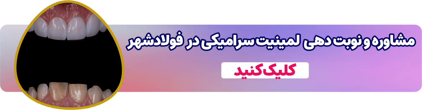 رزرو مشاوره و نوبت دهی لمینت سرامیکی در فولادشهر