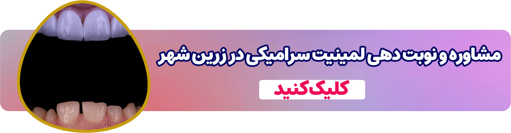 رزرو مشاوره و نوبت دهی لمینت سرامیکی در زرین شهر