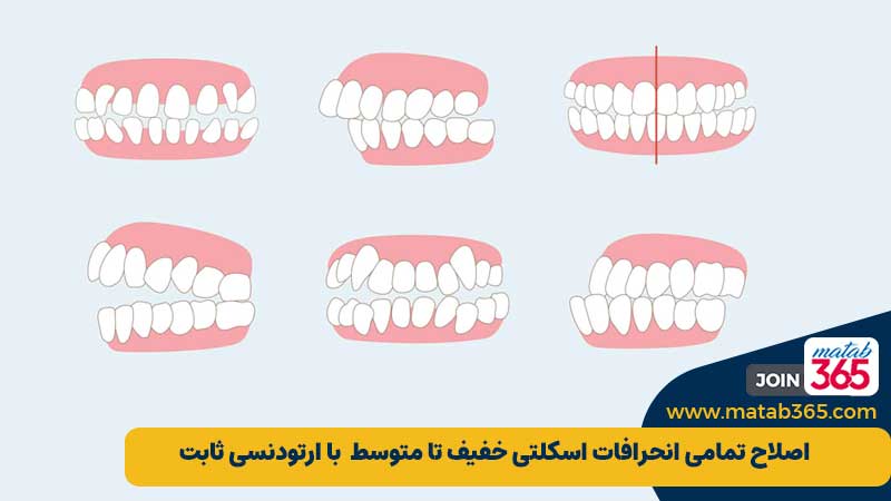 درمان ارتودنسی ثابت برای اصلاح چه مشکلاتی مناسب است؟