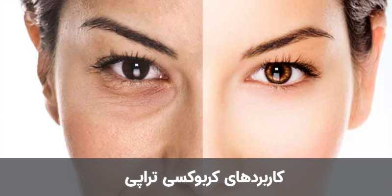 کاربردهای کربوکسی تراپی