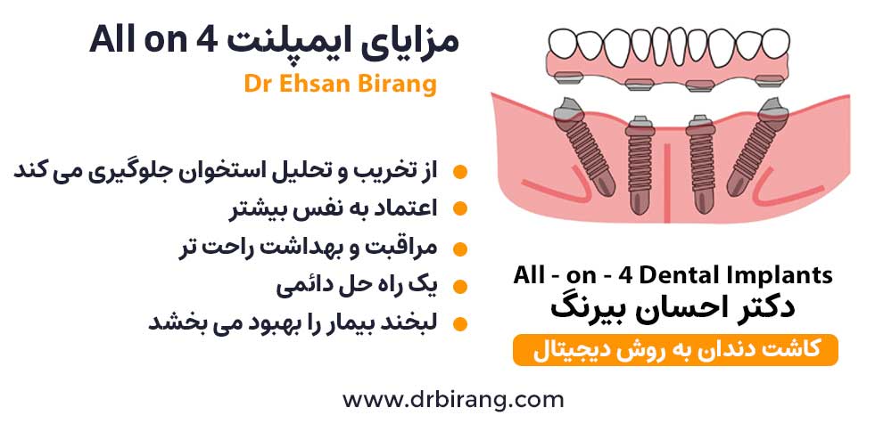 مزایای ایمپلنت All on 4 | دکتر احسان بیرنگ فوق تخصص ایمپلنت فوری در تهران