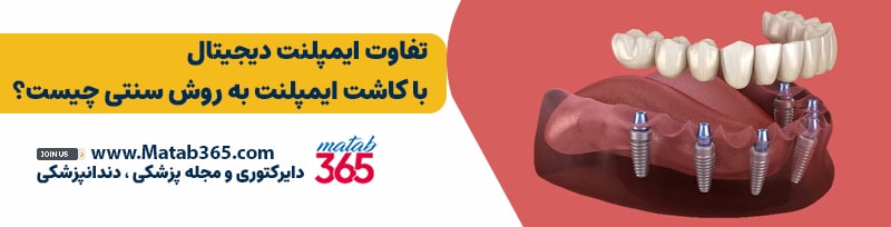 تفاوت ایمپلنت دیجیتال با کاشت ایمپلنت به روش سنتی